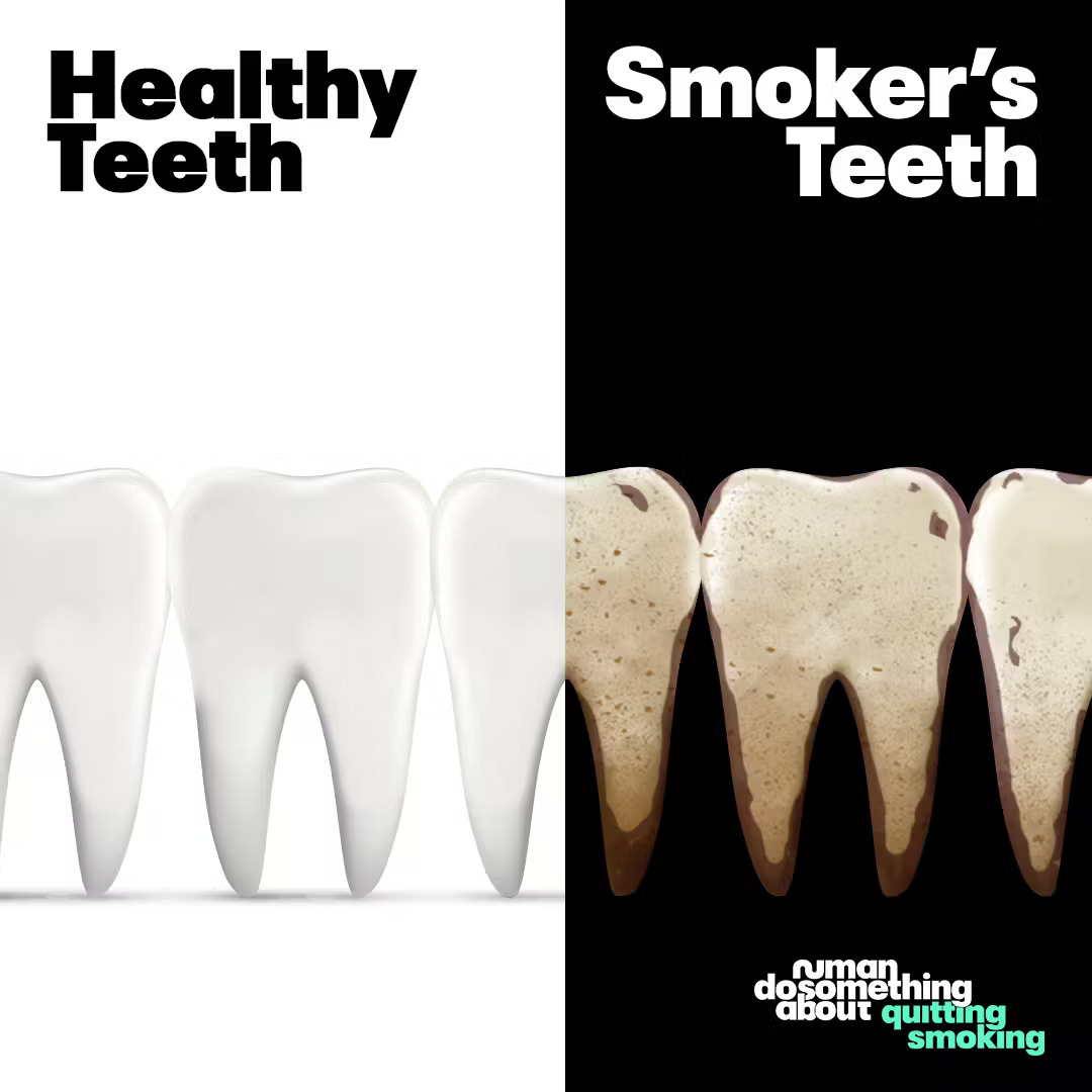 healthy teeth vs smokers teeth healthy teeth vs smokers teeth